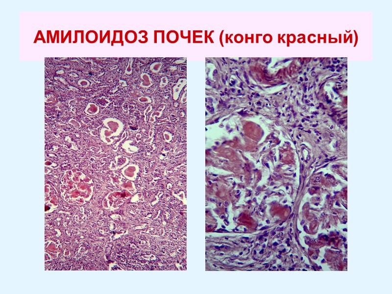АМИЛОИДОЗ ПОЧЕК (конго красный)